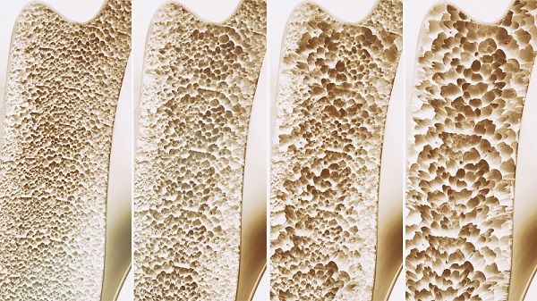 cuatro-etapas-osteoporosis.jpg